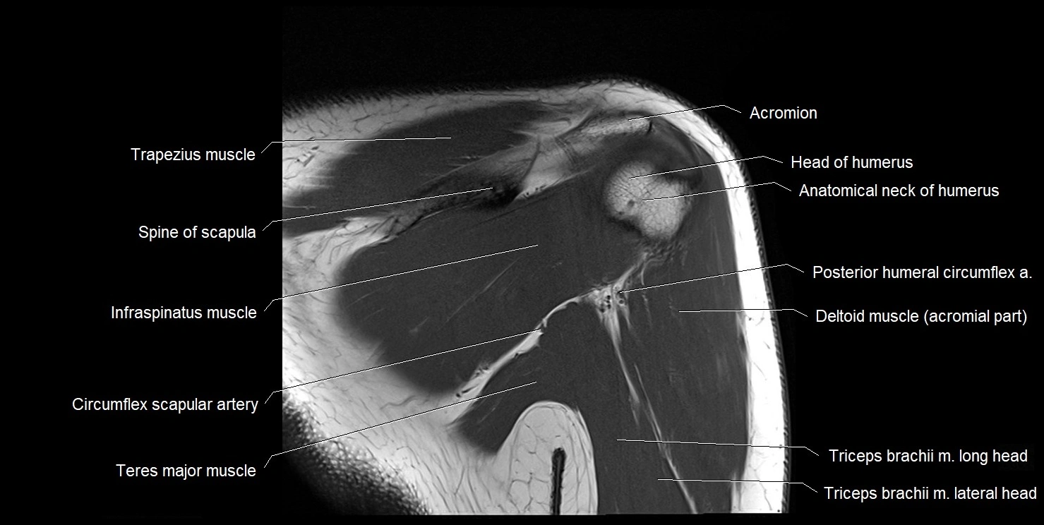 mri shoulder coronal cross sectional anatomy image 15.webp